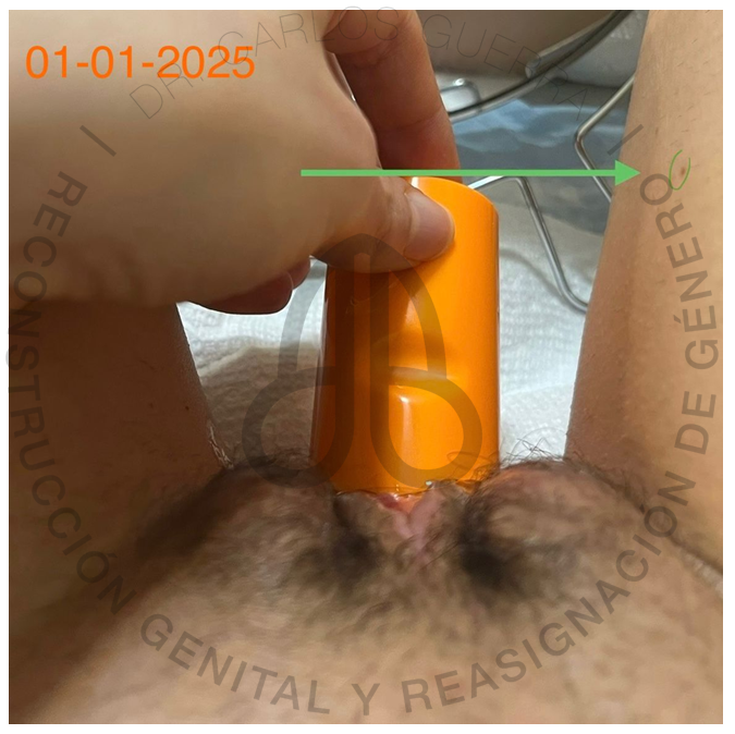 Resultado vaginoplastia